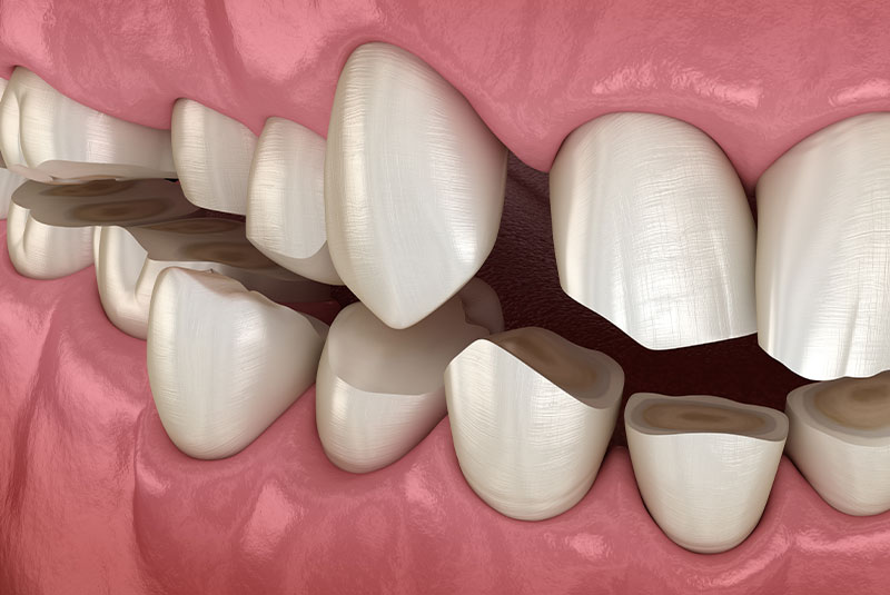 bruxism