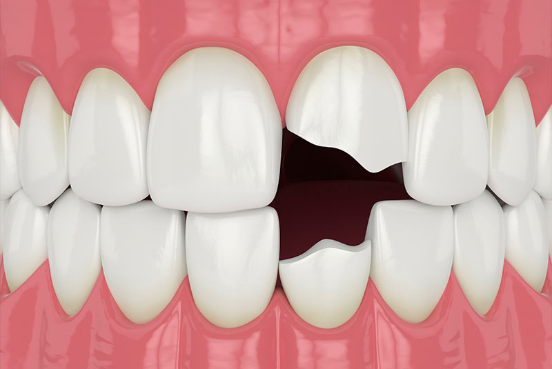cracked tooth