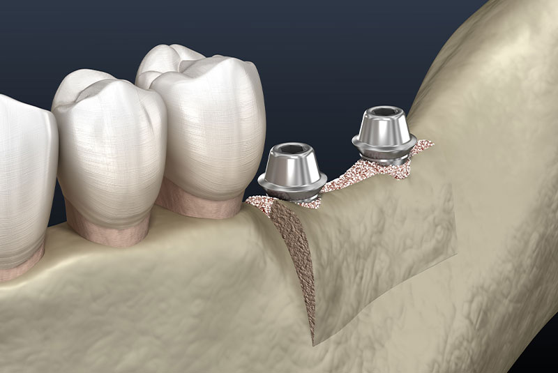illustration of ridge augmentation