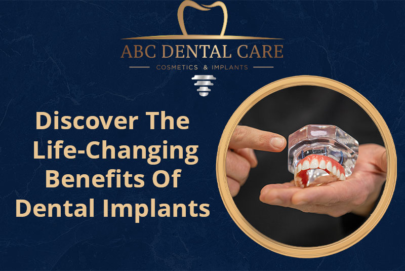 Discover The Life-Changing Benefits Of Dental Implants