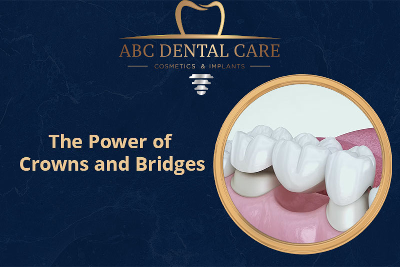 Restoring Your Smile: The Power of Crowns and Bridges
