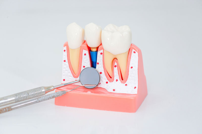 Full Mouth Implants: A Complete Guide to Dental Restoration and Smile Revitalization