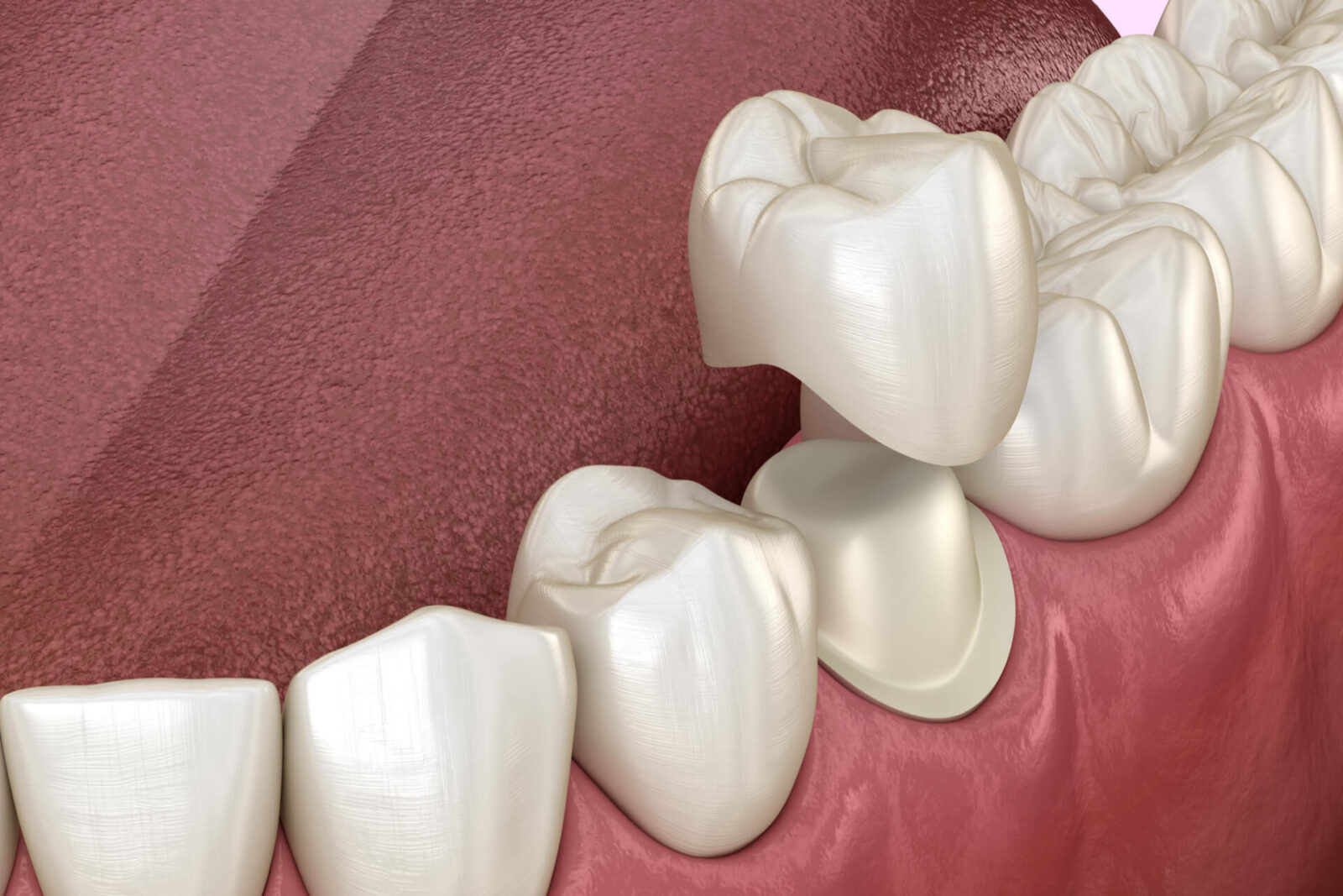 Preparated premolar tooth and dental metal-ceramic crown